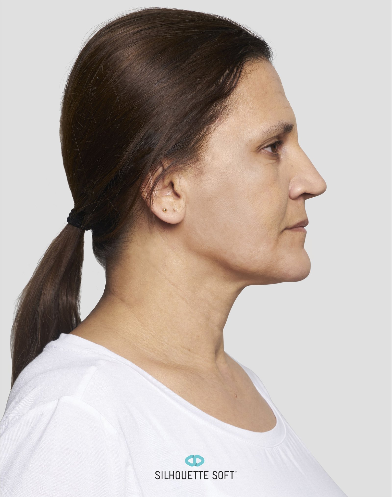 HINDA-MIDFACE-JAWLINE-AFTER-MARKED-min